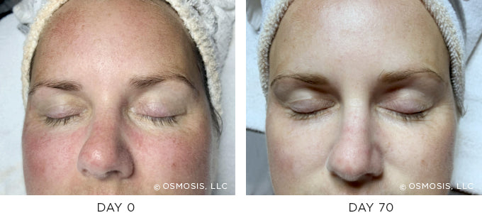 Before and After Photos - Melasma and Aging Skin